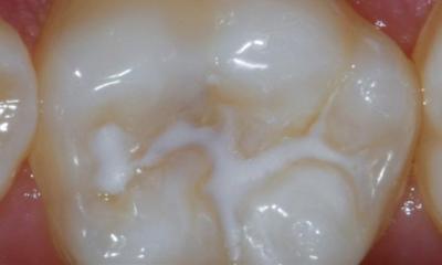 Ein Zahn mit Fissurenversiegelung